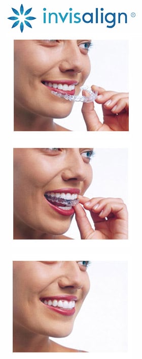 prostowanie zębów